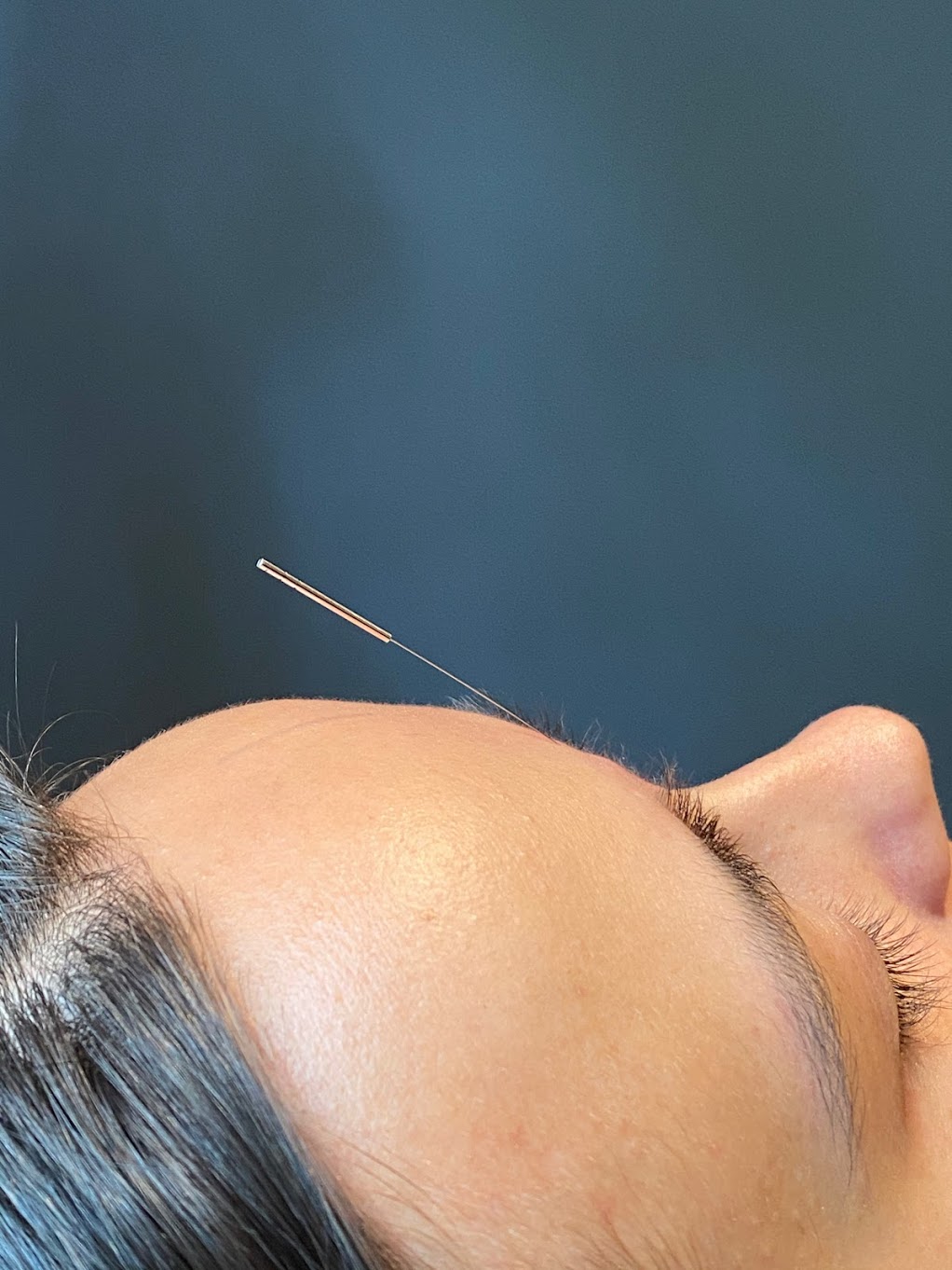 acupuncture at Dulwich physio